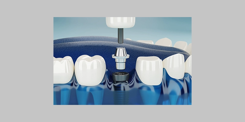 Dent O Clock Treatments